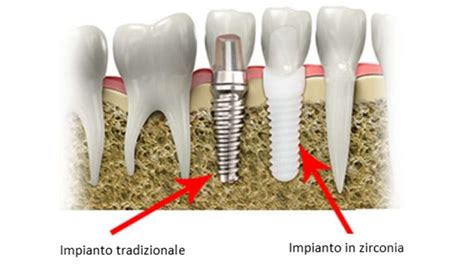  Ossido di Zirconio: Materiale Innovativo per Impianti Dentali e Biocompatibile